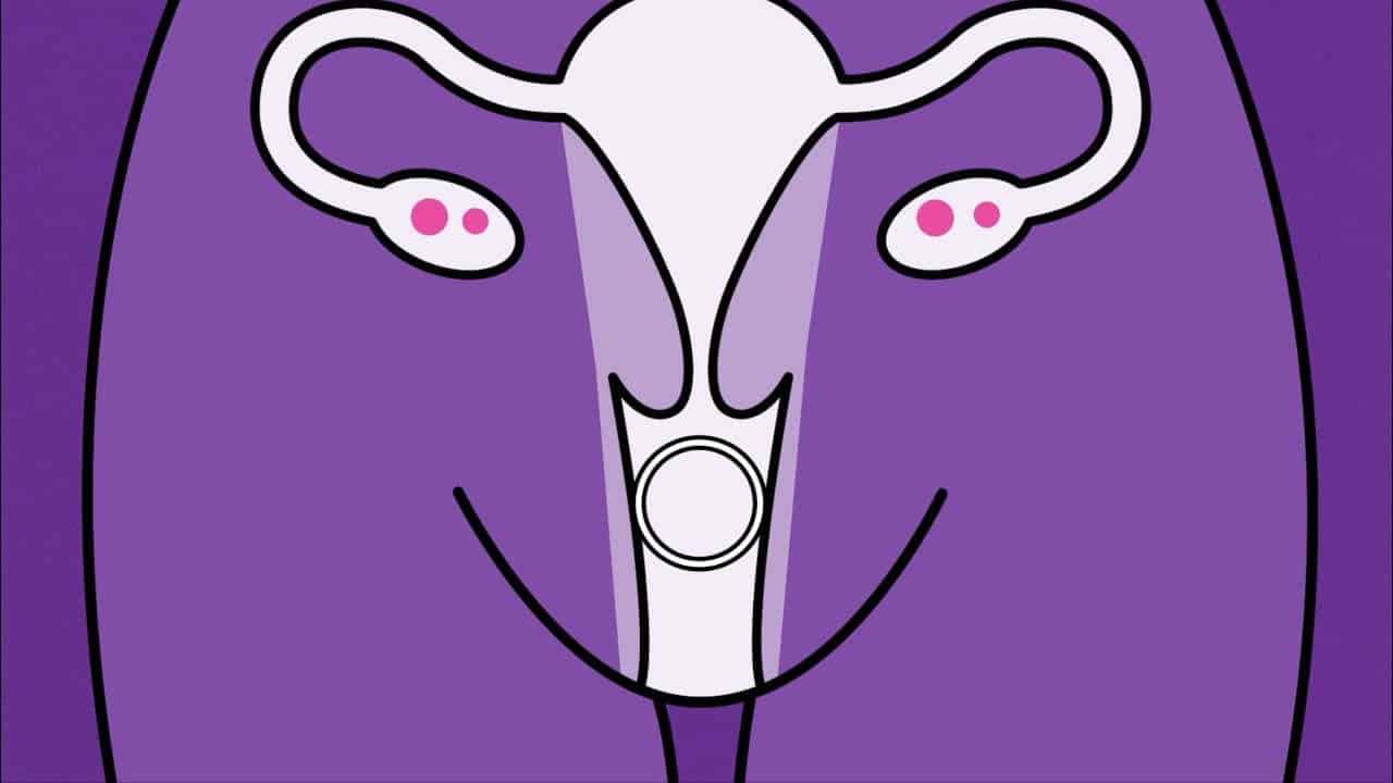 PANCUT DALAM VAGINAL RING