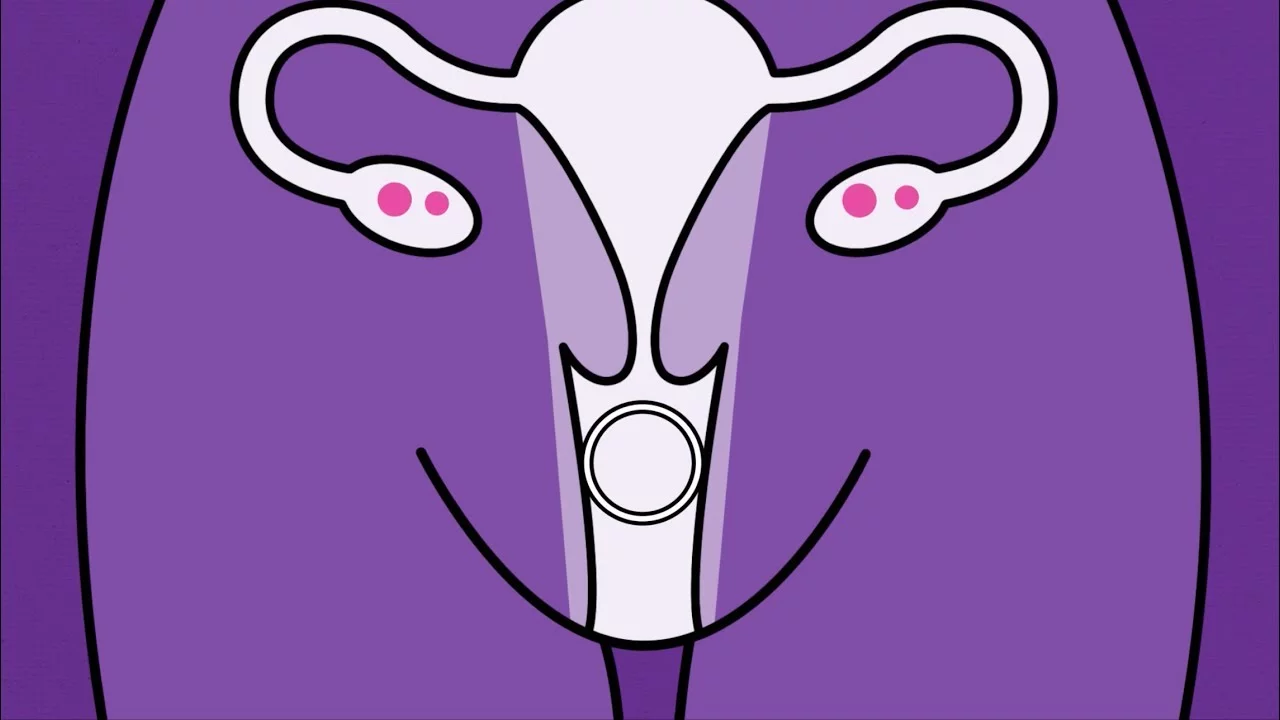 PANCUT DALAM VAGINAL RING