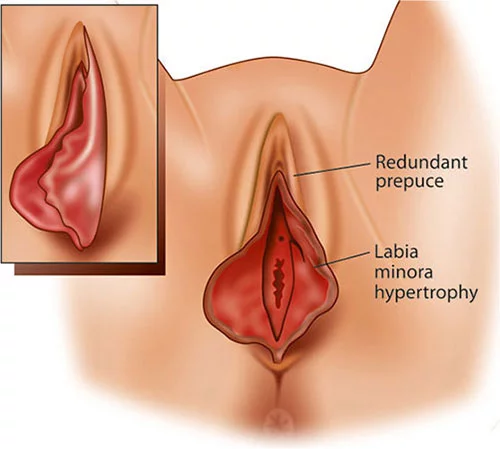 labiora minora pada faraj wanita