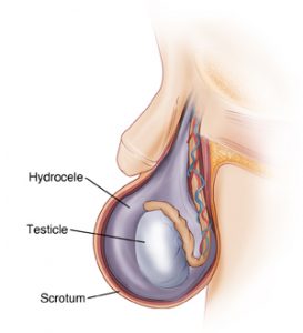 benjol-tanda-kanser-testis