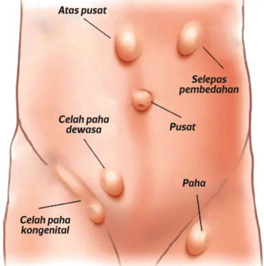 penyakit hernia pada lelaki