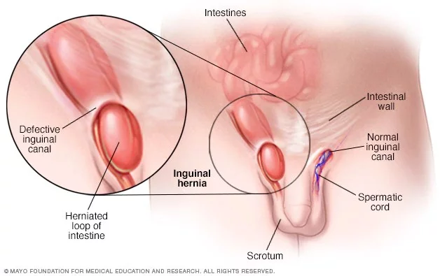 Infografis Penyakit Hernia pada Lelaki