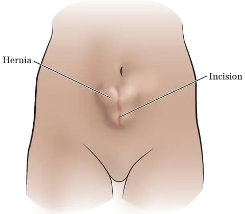 Hernia Inguinalis pada Lelaki