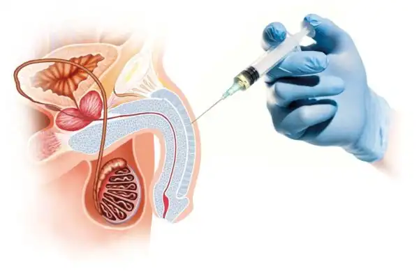 What-Exactly-Is-The-P-Shot?