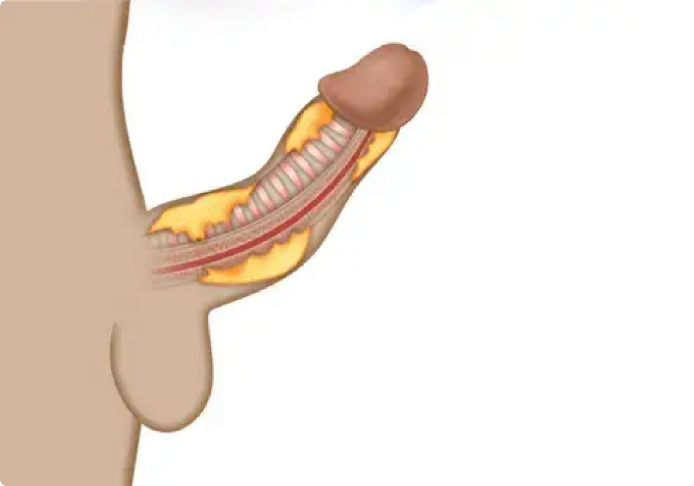suntikan filler dalam islam