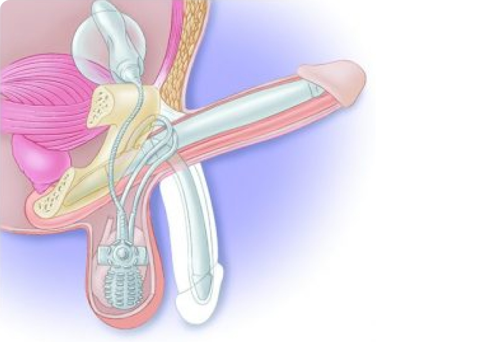 penile size treatment in malaysia