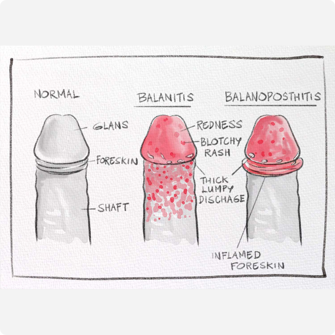 gatal kemaluan lelaki