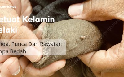 Ketuat Kelamin Lelaki: Tanda, Punca & Rawatan Tanpa Bedah